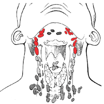 Tongue cancer treatment in KPHB